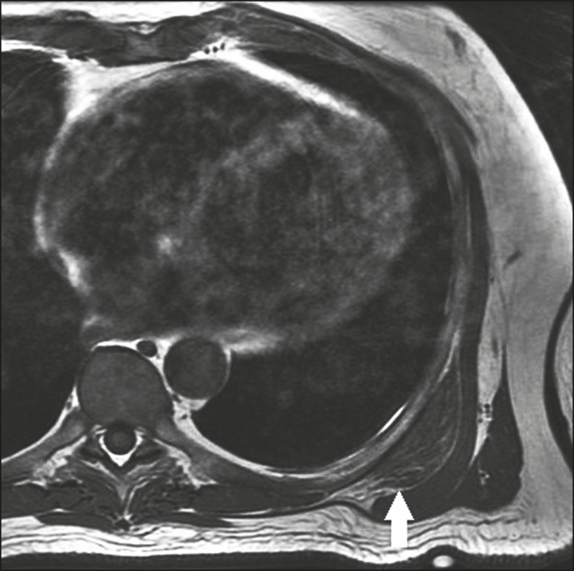 МРТ левой лопатки, показывающая эластофиброму, расположенную между грудной клеткой и нижним углом лопатки.